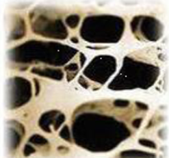 osteoporose
