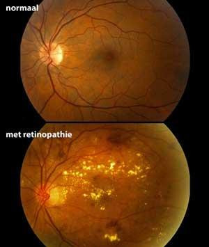 retinopathie