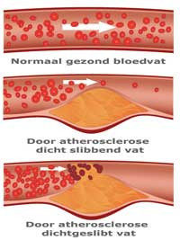 atherosclerose